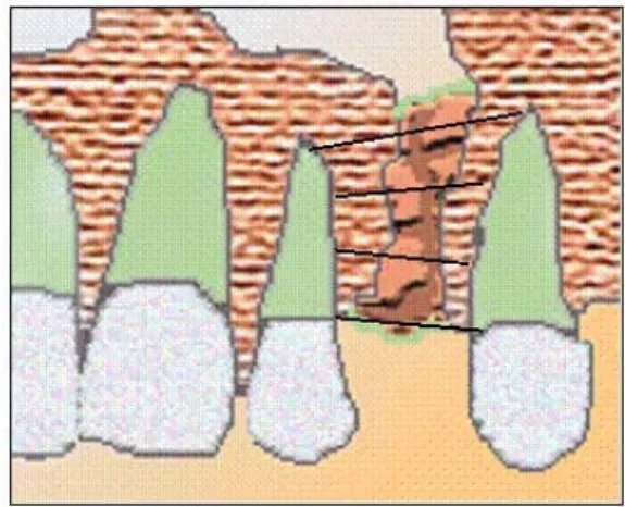 그림 1. Schematic representation of bone resorption level : score 1-the marginal bone level of normal interdental height, score 2-the bone level greater than 3/4 normal height, score 3-the level less than 3/4 normal height, and score 4-no bony bridge achieve