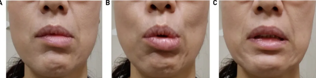 Fig. 2. The photography of 3 months after the surgery. Mild lower lip deviation at resting (A), typical lip twitching at whistling (B)  and lip widening (C).