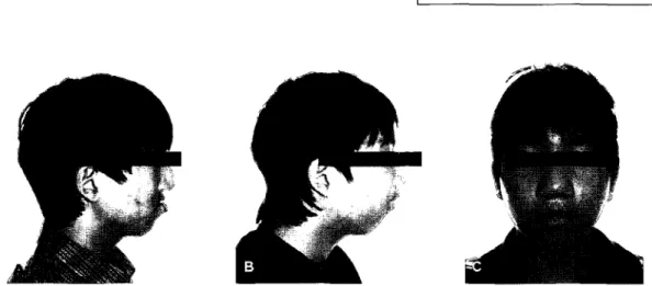 그림  1.  첫  번째 환자의  A,  수술전  구외  측모. B,  견인후 구외  측모  골신장술후 비순각의  증가와  상순의  전방  이동을 확인할 수  있다