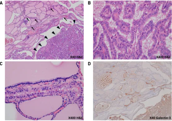 Fig. 3. Histopathologic findings. Papillary thyroid carcinoma was diagnosed. Main mass (arrowhead ( ▶) in (A, B) and intrathyroidal  spread (arrow (→) in (A, C), shows typical features of papillary thyroid carcinoma, which is papillary structures with cent