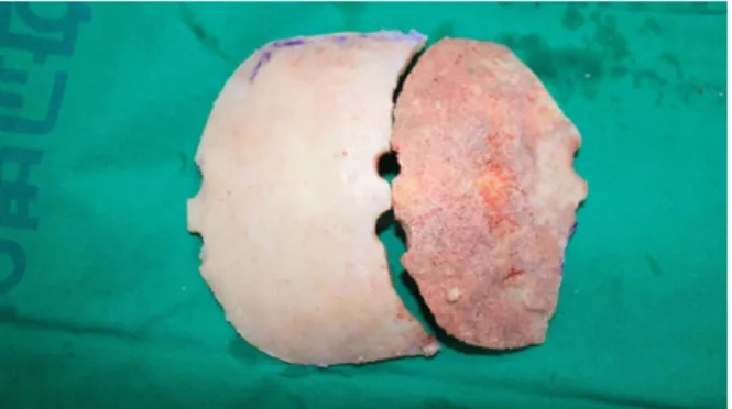 Fig. 4. Intraoperative photograph. The harvested frontal bone was split and reassembled for reconstruction at the defect site.