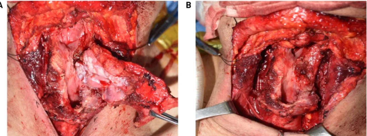Fig. 2. Laryngoscopic finding after induction chemotherapy.