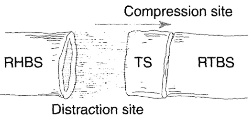 Fig. 3 Bifocal distraction-compression osteosynthesis. RHBS means residual host bone segment; TS, transport  segment; RTBS, residual target bone segment.