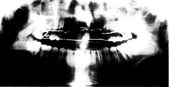 Fig. 7 Pre-op. orthopantomogram. Arrows indicate alveolar bone defect in bilateral cleft lip and palate.