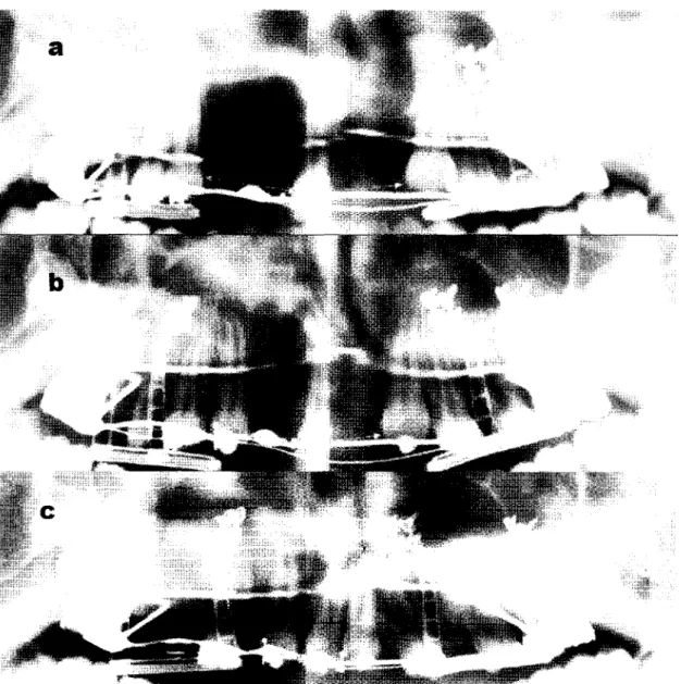 Fig. 10 Orthopantomograms showing the movement of the bony segments and teeth during bifocal distraction­