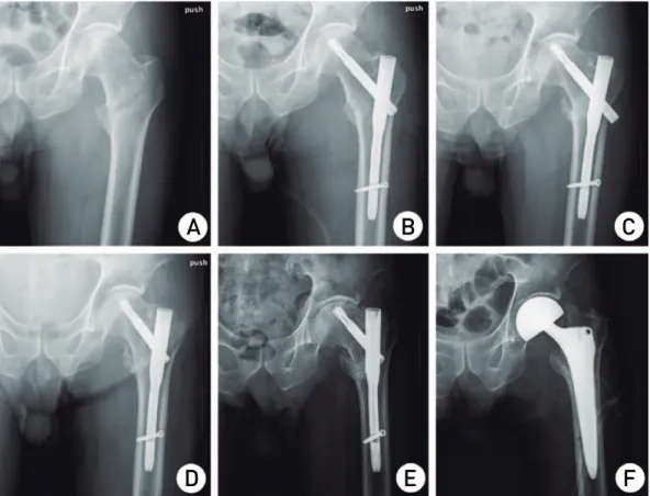 Table 5. Postoperative reduction Loss and Surgical Site Complications