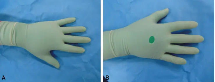Table 2. A Comparison of Cases of Surgical Glove Perforation per Type of Surgery