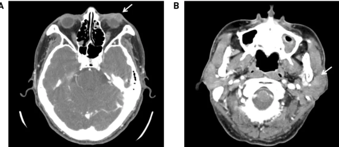 Fig. 1. Preoperative imaging evaluation of the eyelid mass. (A) Enhanced CT scan showed heterogeneous mass in the left lower eyelid (white arrow)