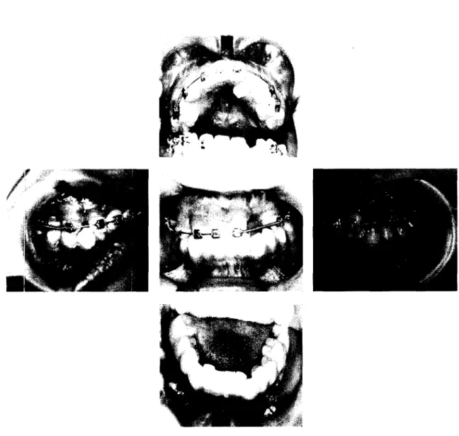 Fig 4. 골신장술후  상악골의  회귀없이  양호한 상,  하악간의 관계를 보이고  있는  구강내 모습