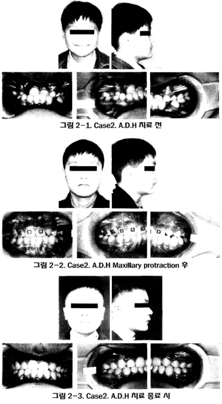 그림 2-1. Case2. A.D.H 치료 전