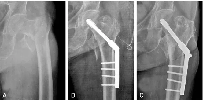 Table 2. Outcomes of Intertrochateric Fractures Treated with Compression Hip Screw (CHS) Fixation Versus Bipolar Hemiarthroplasty (BHA)