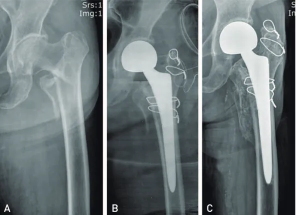 Table 3. Complications after Surgery Using Compression Hip Screw (CHS) Fixation And Bipolar Hemiarthroplasty (BHA)