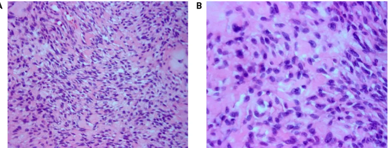 Fig. 3. H &amp; E stain × 200 (A) and × 400 (B) shows tumor consists of typical spindle cell-shape proliferation of myoepithelial cell in a background of myxochondrioid stroma.