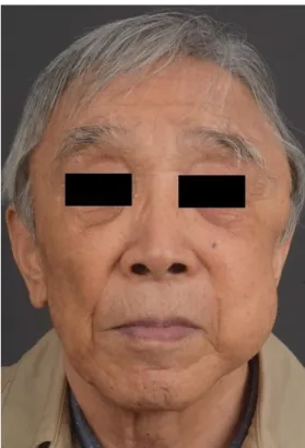 Fig. 2. Pre-operative computed tomographic scan. A pre-operative computed tomographic scan revealed a single large radio- radio-lucent mass extending from the submuscular layer of the left temple, crossing the zygomatic region beneath the zygomatic  arch a