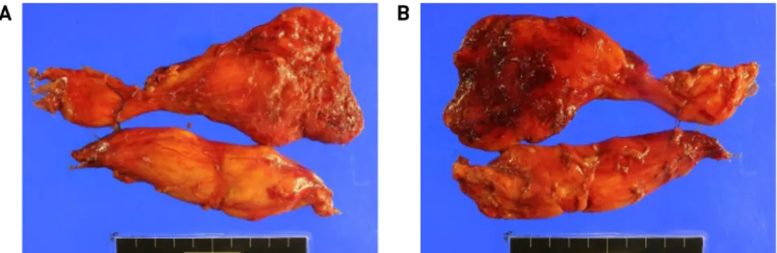 Fig. 4. Specimen photo. The biopsy result was consistent with a lipoma without sarcoma component, and the size was measured 16.5 x 9.0 x 1.2 cm.