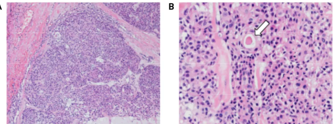 Fig. 4. The microscopic findings. Predominantly solid microcystic structure is shown (H&amp;E stain, x40) (A)