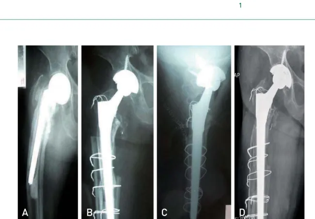Table 1. Stress Shielding on the Last Follow-up Radiographs
