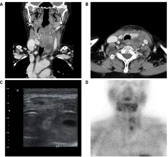 Fig. 1. CT scan demonstrated the presence of a mass below the left thyroid lobe (A, B)