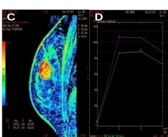 Fig.  3.  The  20  second  images.  Tumor  appeared  well  in  the  post-contrast  image.