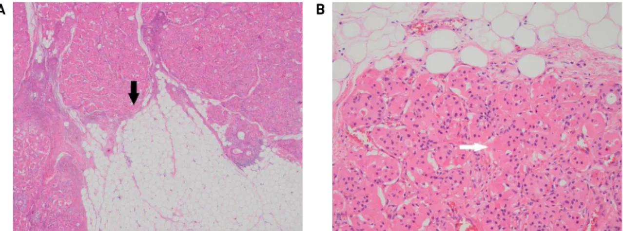 Fig. 5. Microscopically, the tumor was composed of mixed population of oncocytes and adipocytes (black arrow, hematoxylin