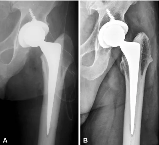 Fig. 1. (A) Immediate postoperative radiograph after total hip replacement arthroplasy with CPT stem
