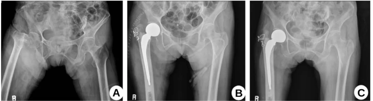 Fig. 1. (A) Initial radiograph in 89 year-old woman shows unstable intertrochanteric fracture according to AO/OTA classification.