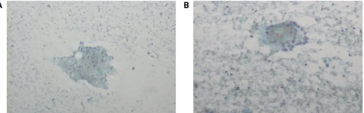 Fig. 2. FNAB findings. A few atypical oncocytic cells (A, ×200), a few multinucleated giant cells and atypical oncocytic cells  (B, ×200) in the necrotic background were suggestive of Warthin’s tumor.
