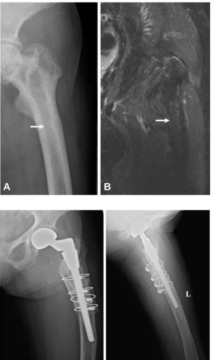 Fig. 7. (A) It shows incomplete pathologic fracture in the lateral cortex on the both plain x-ray and (B) MRI.
