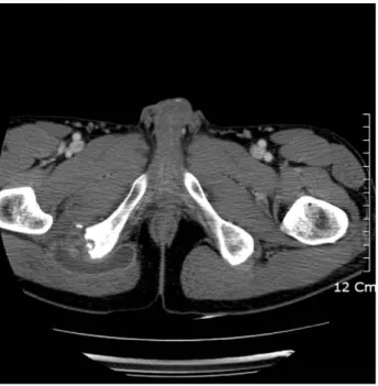 Fig. 2. X-ray shows multifocal bony destructive lesion with round shape.