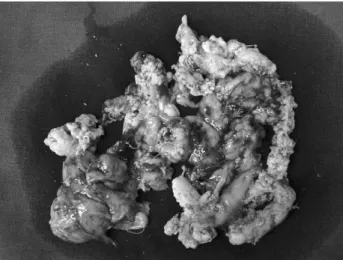 Fig. 5. A posterior surgical approach to the ischium. Fig. 6. The removed tissue showed a cheese like appearance and was closed to the pattern of caseous necrosis.