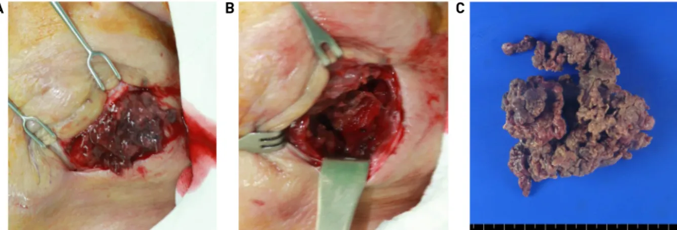 Fig. 3. Operative findings. It shows sudden gush out foul odorous fluid and internal content from the mass (A)