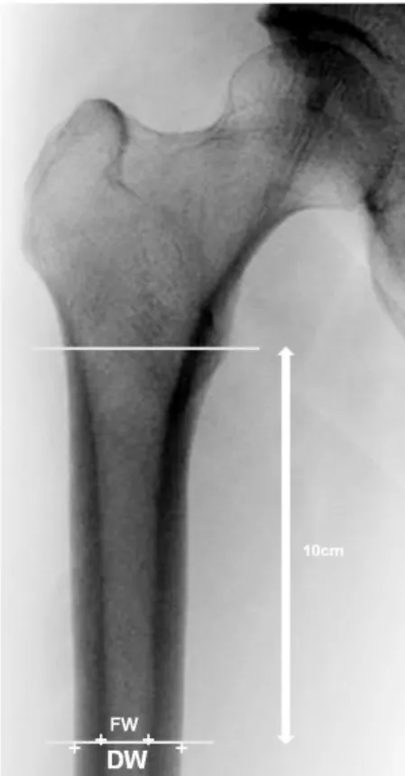 Fig. 1. Measurement of calcar-to-canal ratio by FW/CW on anteroposterior radiograph of the hip.