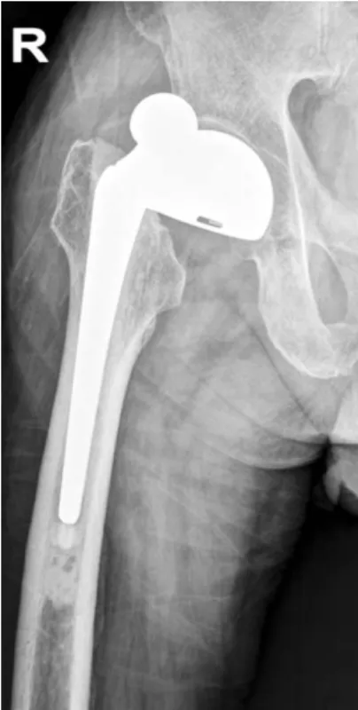 Fig. 2. (A) Retrieved bipolar components without any damaged beveled over the outer head and wear of polyethylene insert