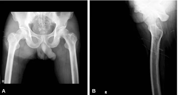 Fig. 4. Plain radiograph after 6 weeks of operation shows multiple lines without any bone destruction or fracture.