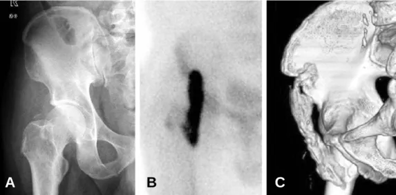 Fig. 2. During operation, there is Immature heterotopic ossification in iliac muscle.