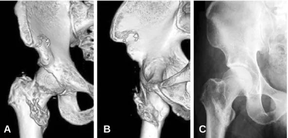 Fig. 3. (A) (B) 3D CT Image 6 weeks later from the operation, there is Immature heterotopic ossification around lesser trochanter partially