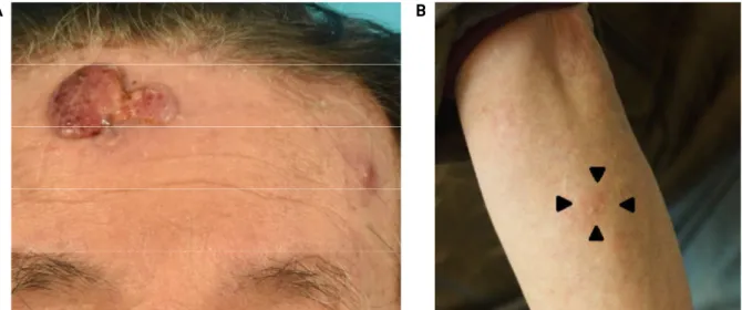 Fig. 1. Preoperative photos. A: A facial photo on the first visit to the hospital. A 40×23mm-sized brownish red nodule with an  irregular shape was at the left paramedian area of the forehead