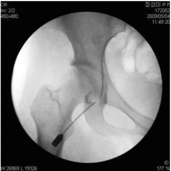 Fig. 3. With X-ray image intensifier, aspiration of the cyst using 18 gauge bore needle.