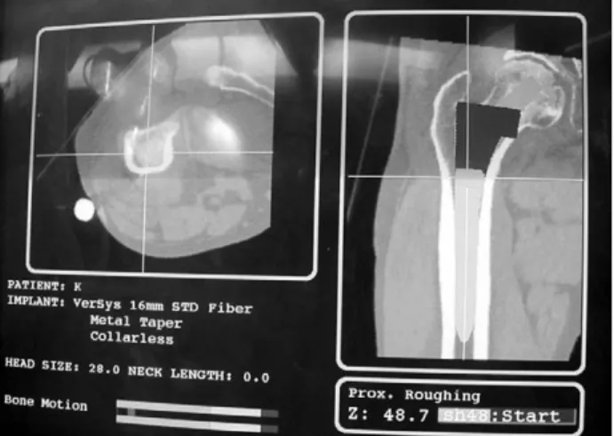 Fig. 2. (A) After incise the skin as a routine manner and expose the acetabulum, the cotyloid fossa and acetabular surface, indluding margin, must be acquired using multiple landmark acquisition