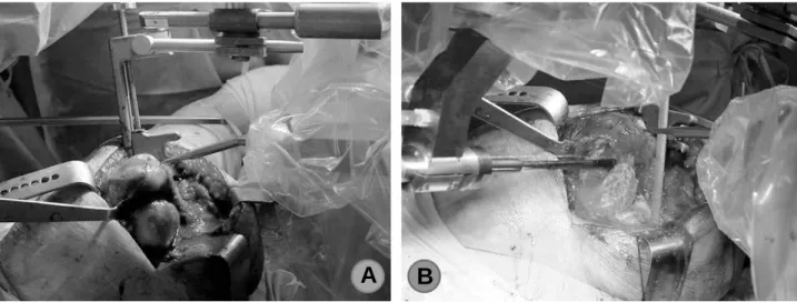 Fig. 3. (A) The bone should be securely fixed with robot machine with fixator and the soft tissue should be retracted safely