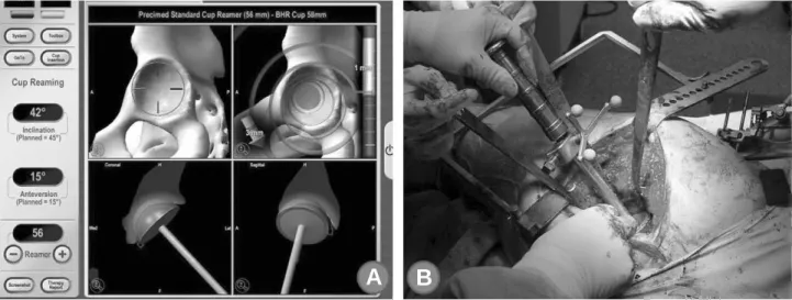 Fig. 4. (A) The planned inclination and version values for the implant are shown during reaming and the values are updated dynamically