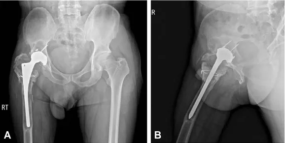 Fig. 1. Osteolysis on acetabular and femoral area. (A) Combined deficiency on superior and anterior acetabular area, and severe proximal femoral bone loss with medial cortical bone breakage in 52-year-old man who underwent primary surgery before 20 years