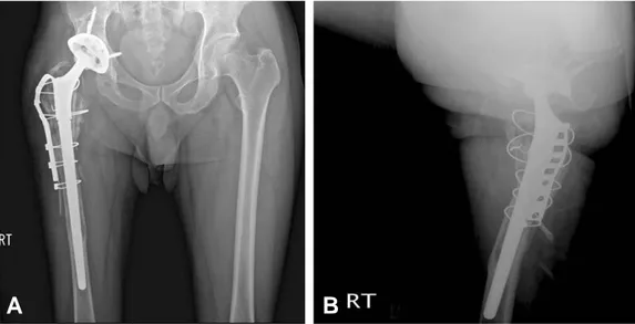 Fig. 3. Revision surgery was accomplished by substitution of acetabular component, liner and femoral stem