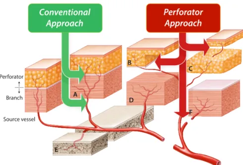 Fig. 2. Evolution of fibular osteomyocutaneous(OMC) or osteocutaneois (OC) compound flap to perforator flap for tailored  reconstruction