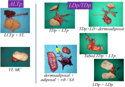 Fig. 3. Evolution of chimeric flap from the conventional compound flap to perforator based chimeric flap