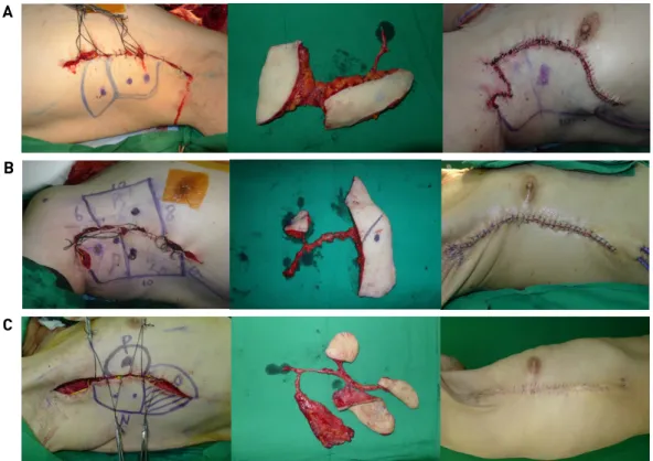 Fig. 4. Various tissues from lateral thoracic area. Adiposal, der- der-moadiposal, muscle, bone, and skin flaps can be included  in chimeric pattern depending on the recipient condition