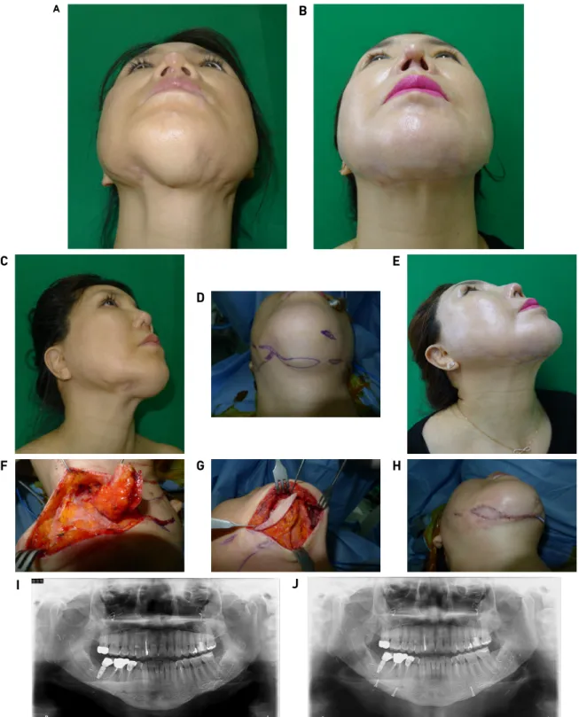 Fig. 7. Perforator based island flaps for the correction for chin irregularity after contouring operation.