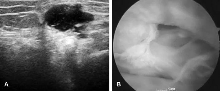 Table 1A. This table shows comparative relationships of positive or negative results of ultrasonographic and arthroscopic finding on medial meniscus and lateral meniscus pathology of our study