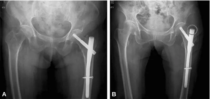 Fig. 4. Comparison 2 cases which has same neck-shaft angle (about 135。): (A) Using of 130。-angulated PFNA and protruded nail