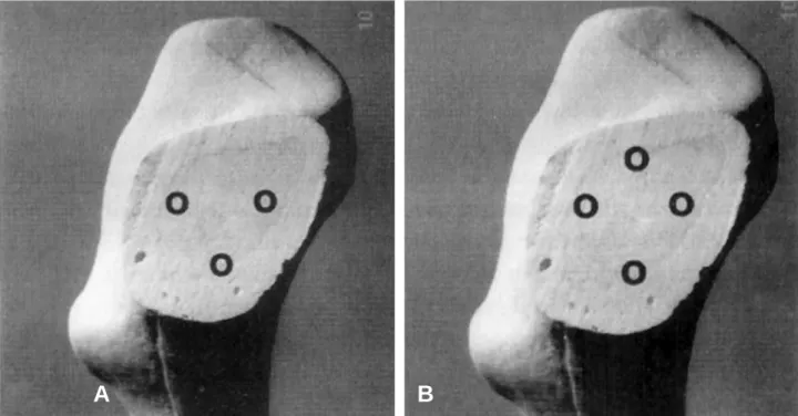 Fig. 6. Preferred surgical technique of multiple cannulated screw fixation. (A) Fixed guides for triangle or diamond patterns